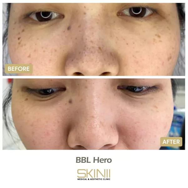 Skin111