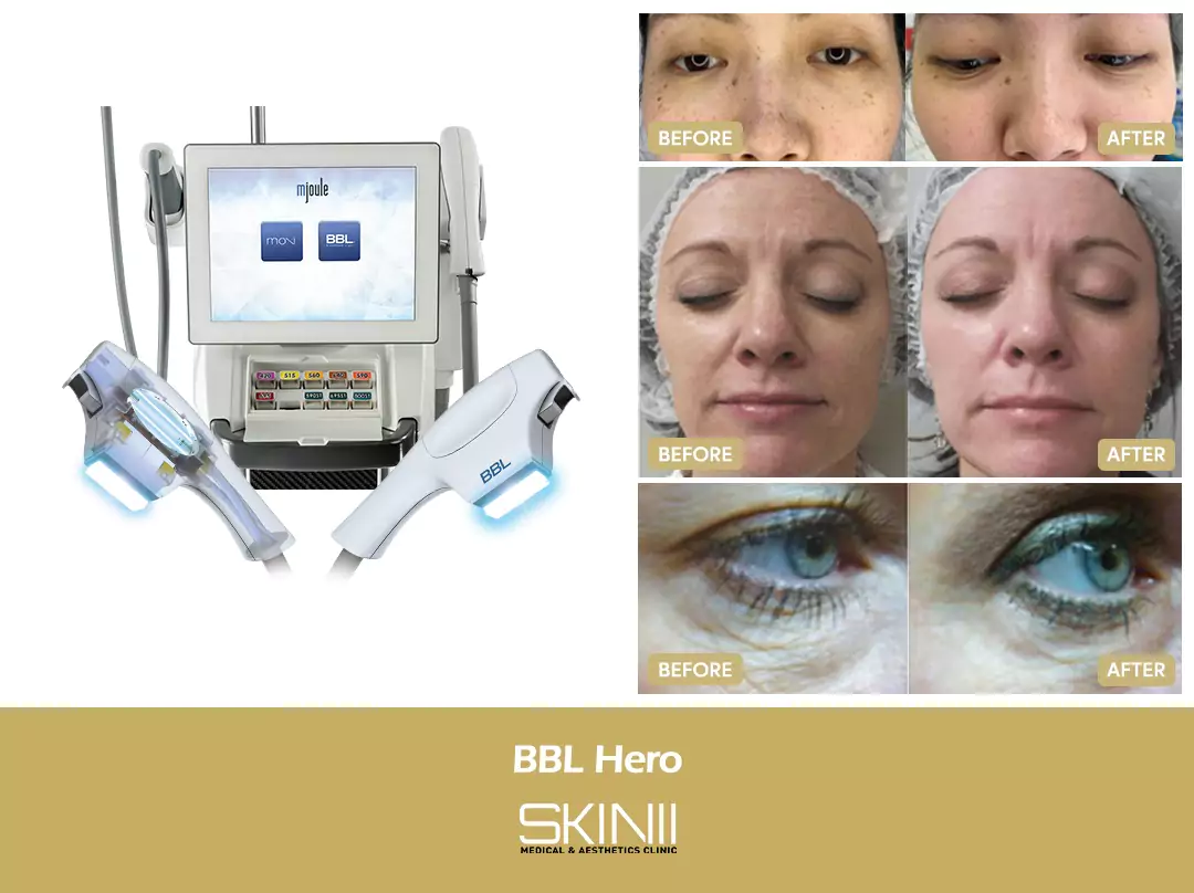 Skin111