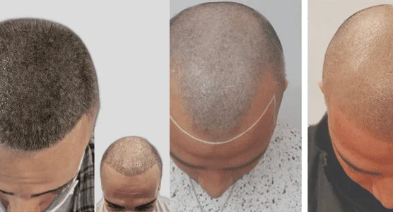 Scalp Micropigmentation (SMP)